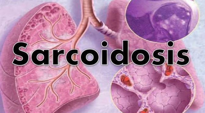 Sarcoidosis What Is It?